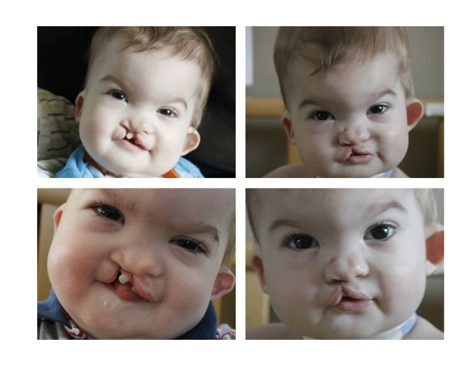 A couple of Before and After stage one cleft lip and palate surgery you were all praying us through back in May. What a difference already!